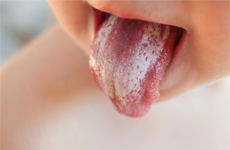 [Translate to Japanese:] Tongue of a toddler with white plaque